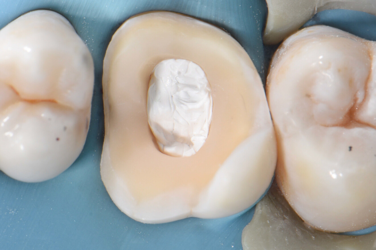 Fig. 15a: Access cavity closed with PTFE tape.