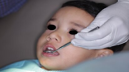 Fluoride varnish application aids in prevention and progression of caries in children