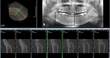 Η παραδοσιακή απεικόνιση δε θα εξαφανιστεί με την εφαρμογή της Υπολογιστικής Τομογραφίας Κωνικής Δέσμης-CBCT