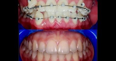 Ortodoncia fija sin brackets con la técnica SLIDE OD