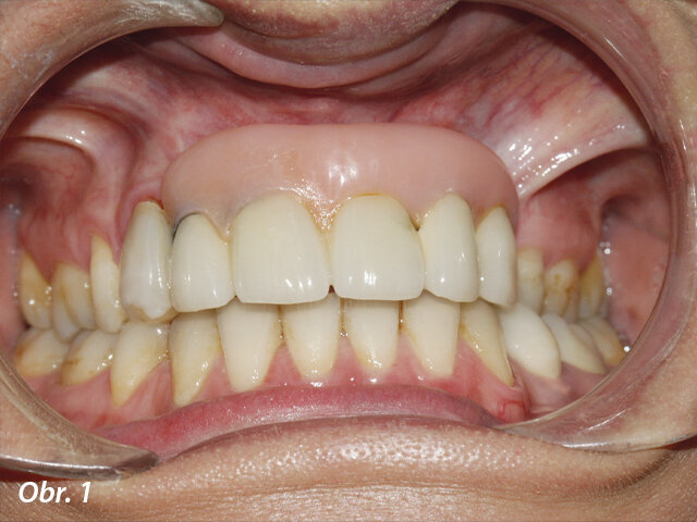 Prvotní náhrada: opora rtu byla zajištěna rozsáhlou umělou gingivou a u pravého horního špičáku bylo patrno odlomení estetického materiálu. Úsměv pacientky odhaloval protetické zuby umístěné mimo středovou osu a prosvítání konstrukce u pravého postranního řezáku.