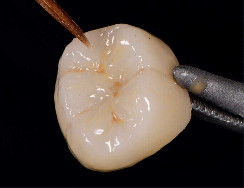 Fig. 4. Maquillaje y glaseado de la corona.