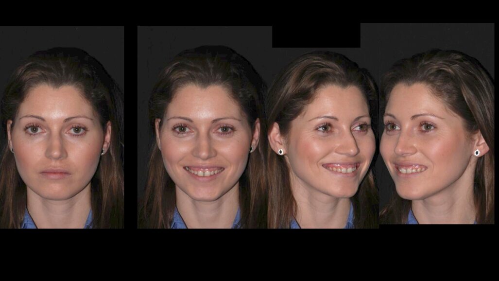 El embellecimiento de sonrisas con ácido hialurónico