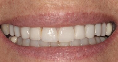 Er:YAG laser-assisted removal and recementation of a malpositioned lithium disilicate veneer