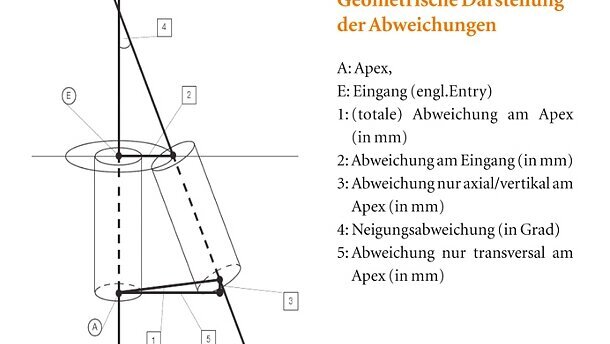 Genauigkeit der computerassistierten Implantationsarten