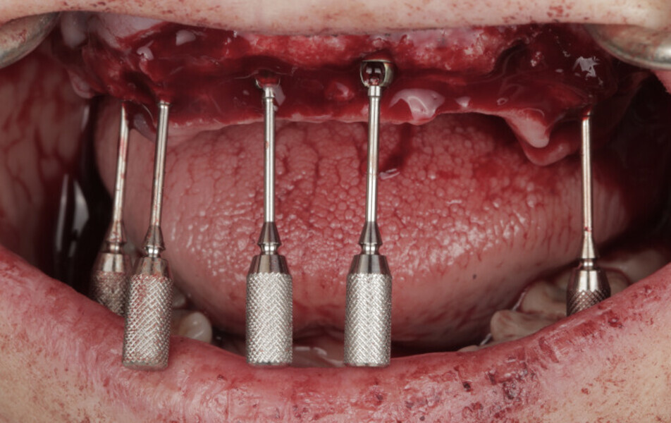 Fig. 11: Multi-unit abutments attached to the implants.