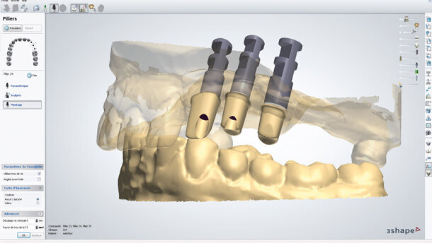 Realizzazione di un abutment implantare customizzato mediante CAD/CAM: una soluzione specifica per ogni caso clinico