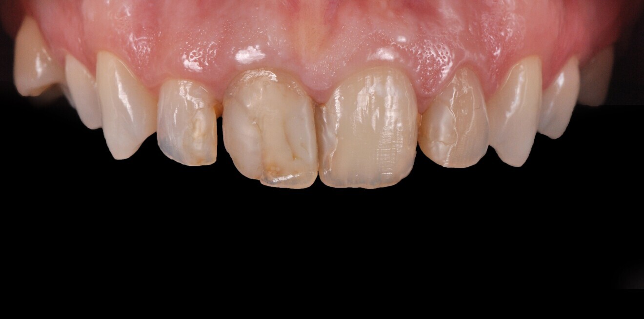 Fig. 2: Close-up of the patient’s maxillary anterior teeth.