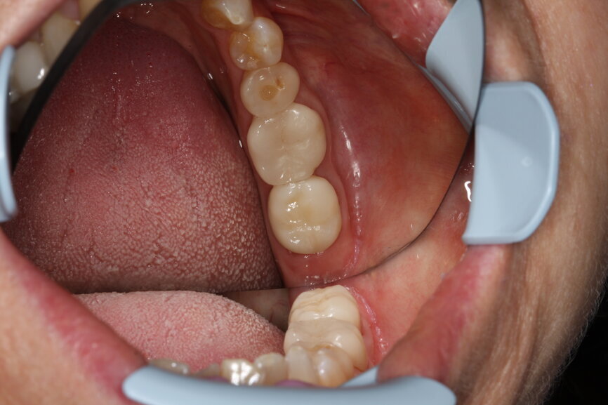 Fig. 6: Final situation of tooth #37.