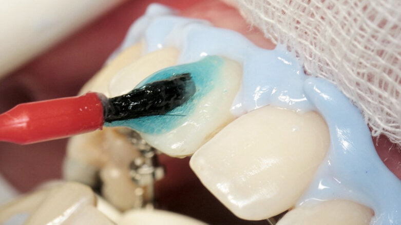 Bělení zubů a ortodoncie: třešnička na dortu