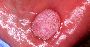 ¿Sabe qué responder a sus pacientes sobre el VPH?