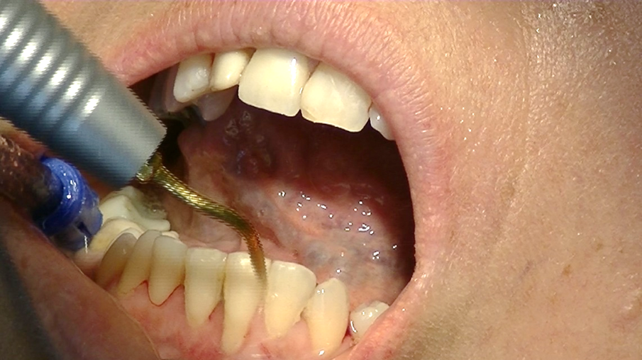 Figg. 8a, 8b - Strumentazione sonica in parodontologia. Impostando il grado di potenza sul livello 1 si induce una oscillazione degli inserti di 120-150 µm ottenendo effetto ablativo efficace ed estremamente delicato per il paziente. 