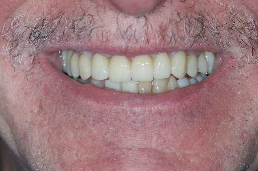 Fig. 5a_Visione frontale della riabilitazione protesica definitiva.