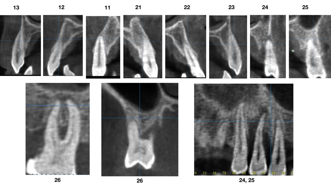 Fig. 4: CBCT scan showing the bone condition of the maxillary teeth. Vertical resorption and reduced thickness of the buccal bone plate of the right and left central incisors were evident.