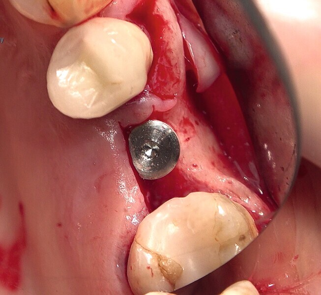 Fig. 40 : Pose de l’implant deux pièces en céramique au niveau tissulaire. 