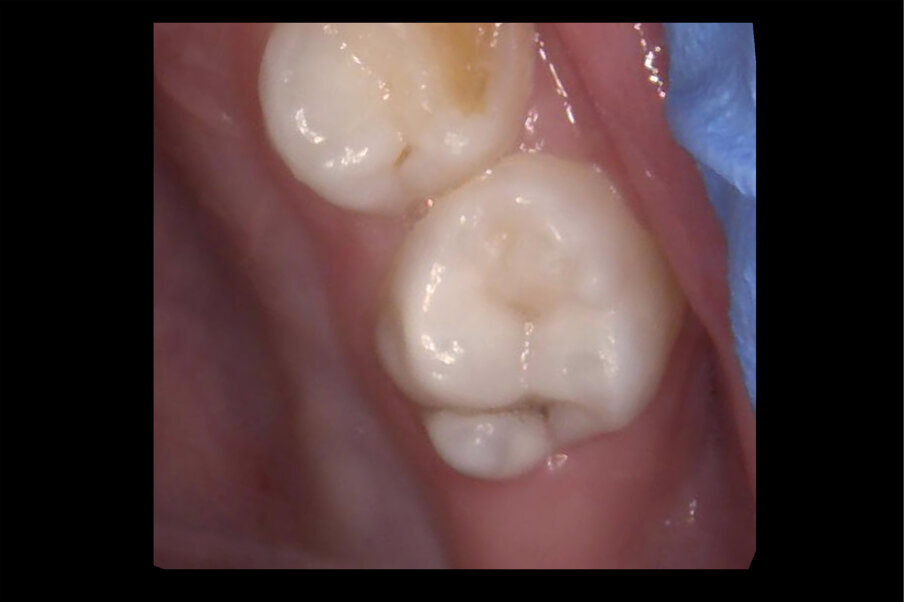 Afbeelding 8. Casus 3: 13-02-19. Intraorale foto 65 bij 3-jarig kind met zuigflescariës.