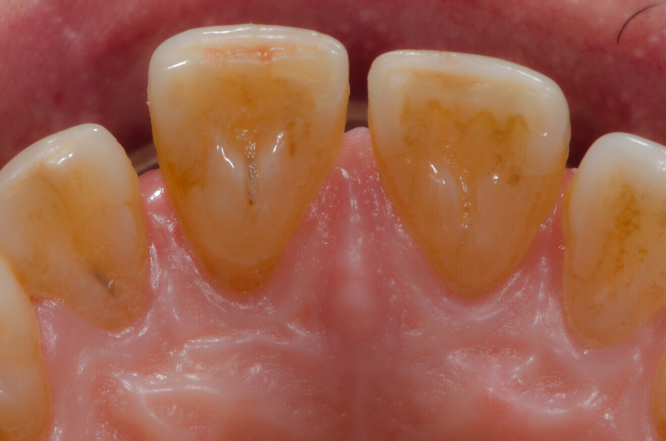 Fig. 1d: Initial intra-oral photographs of tooth #11, palatal view.