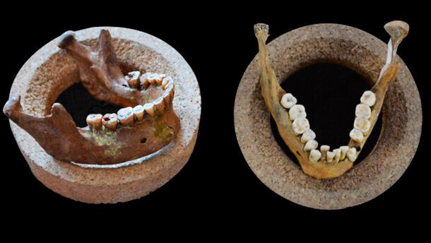 Dallo studio di reperti si è scoperto che anche i primi agricoltori soffrivano di malocclusione