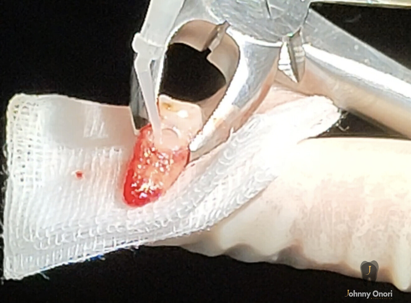 Fig. 4b: Finally, the cavity was filled with Geristore (DenMat). 