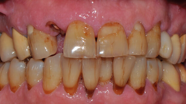 Impianti post-estrattivi immediati nei settori estetici: l’importanza della selezione del caso tramite un esame CBCT ad alta risoluzione