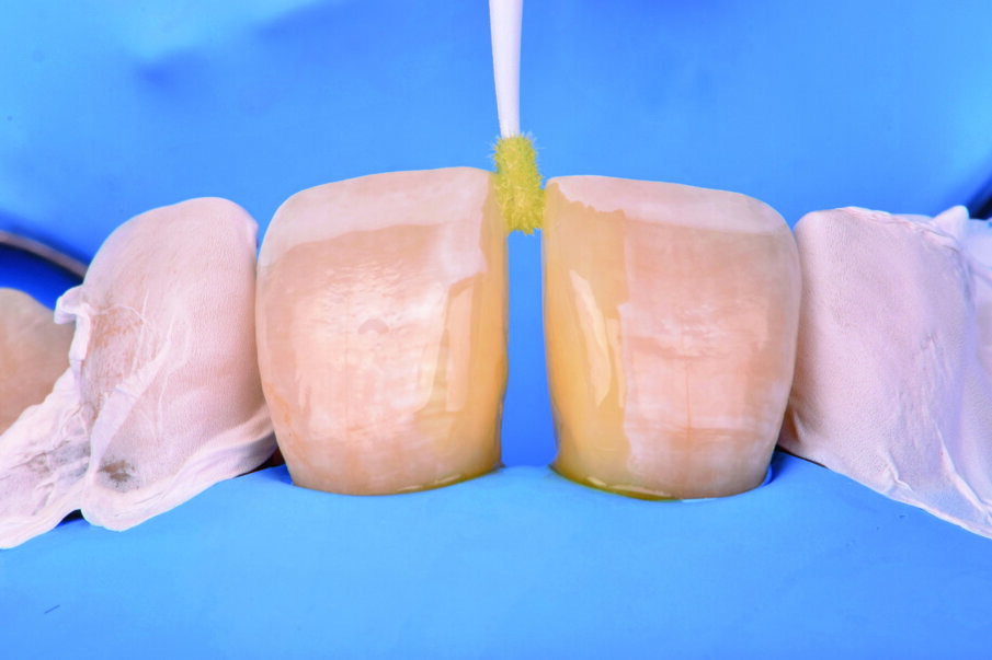 Fig 9. Application of FL-Bond II bonding agent