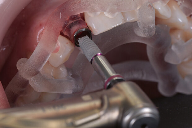 Fig. 10. Implant insertion (NP implant, MIS) with drill template