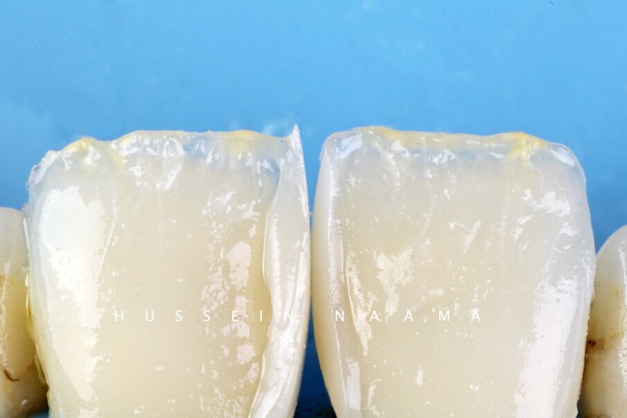 Fig. 11: Characterization of incisal area with Lite Art internal stains # Yellow & White.