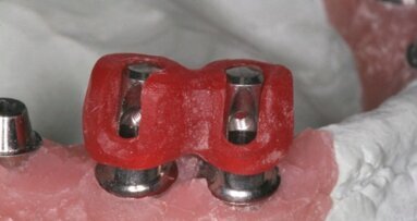 Tomografia komputerowa i możliwości CAD/CAM w planowaniu i leczeniu trudnych przypadków klinicznych