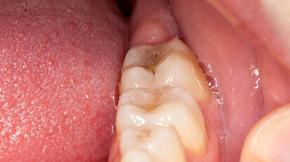 Amostra de saliva pode revelar doenças graves