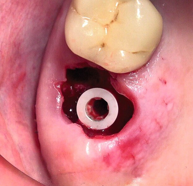 Fig. 52 : Pose de l’implant deux pièces en céramique.