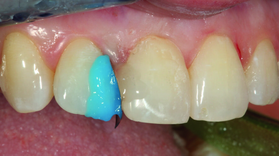 Afbeelding 4. Na proximale opbouw van element 11 met OMNICHROMA: bekisting van element 12 voor zijn mesiale opbouw.