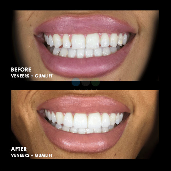 Figs. 39a & b: Patient’s smile (a) after aligner treatment and (b) after veneers and soft-tissue recontouring.