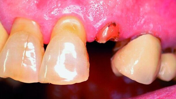 Facteurs de réussite de l’implantation immédiate avec mise en charge immédiate -  Une étude de cas