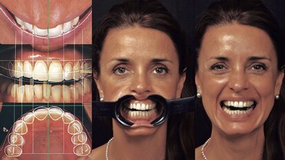 Estética y blanqueamiento dental en la era digital  (Capítulo 12)