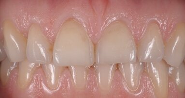 Réhabilitation biomimétique de deux centrales érodées