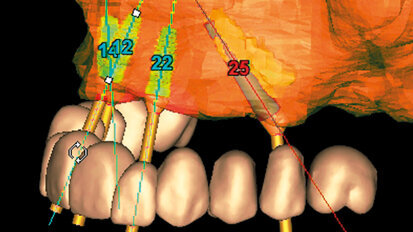 Impianti trans-sinusali per la riabilitazione del mascellare atrofico: serie di 32 casi in pazienti totalmente edentuli