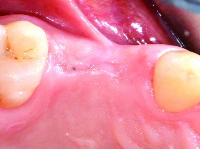 Fig. 3_Visione occlusale della sella edentula: si può apprezzare l’inserzione bassa del frenulo vestibolare laterale.