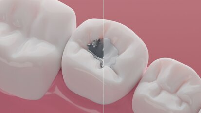 EU gỡ bỏ lệnh cấm Bắc Ireland sử dụng vật liệu trám răng bằng amalgam