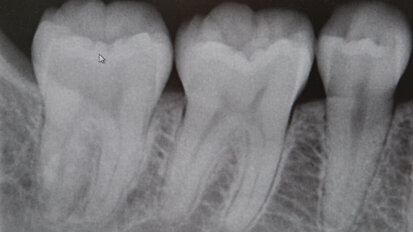 Vitamin-D-Mangel auf Röntgenbildern erkennbar Vitamin-D-Mangel auf Röntgenbildern erkennbar