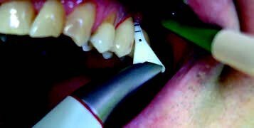 Fig. 9: Removal of biofilm with the PERIO-FLOW® handpiece