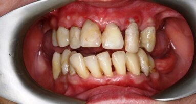 Zastosowanie lasera Er:YAG w leczeniu kieszeni przyzębnych