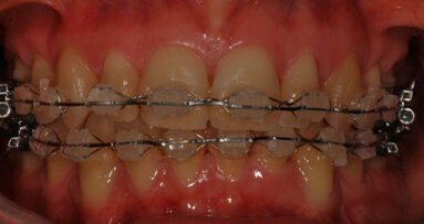 Case Report sulla riabiltazione protesica