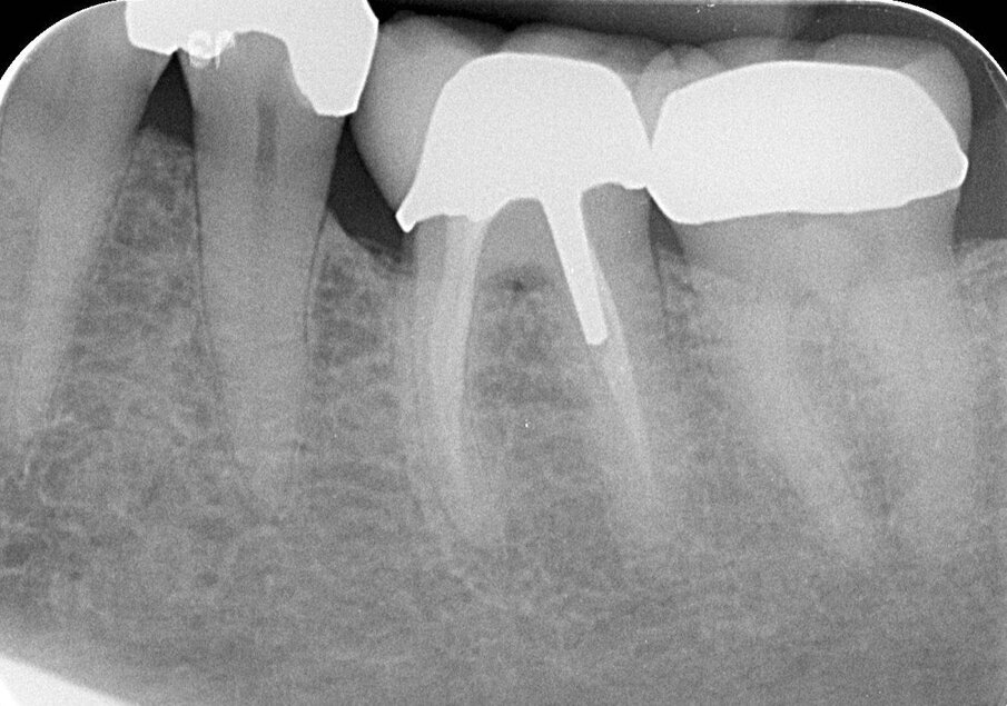Afb. 8: Röntgenfoto van de 37-jarige follow-up van de 36