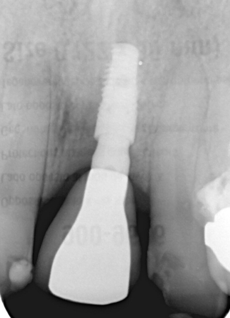 Fig. 13_Rx a 1 anno. Notare la quantità di tessuto osseo al di sopra della platform.