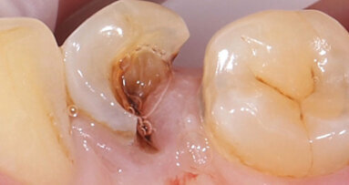 Restauración mediante endocorona de cerámica de feldespato