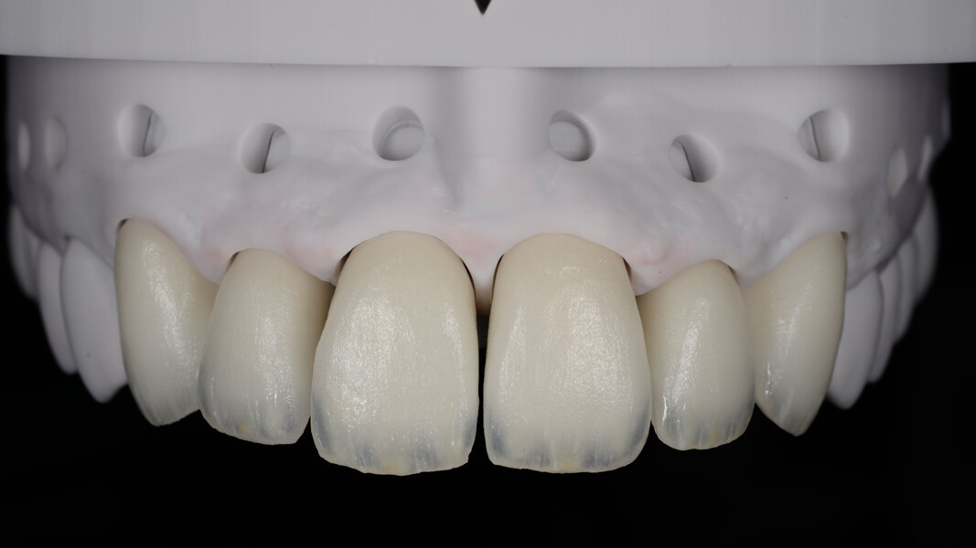 Fig. 18: Creation of mamelons and incisal effects using CERABIEN ZR internal stains.
