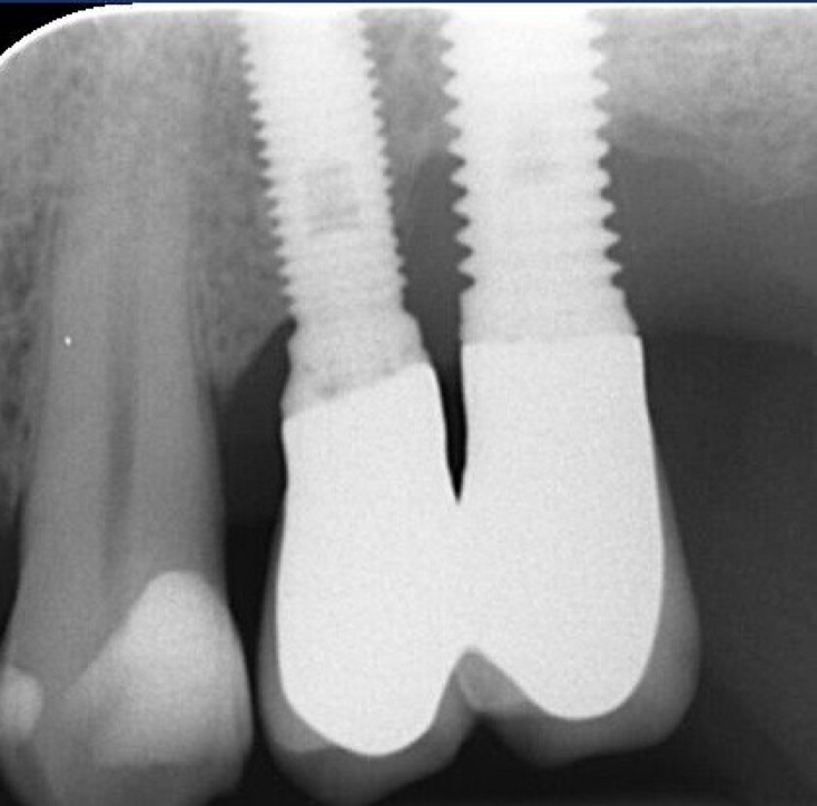 Fig.21: Case 2. 12 months radiographic check. 