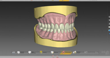 Protesi totale con inLab Software 20.0 – Semplicemente digitale