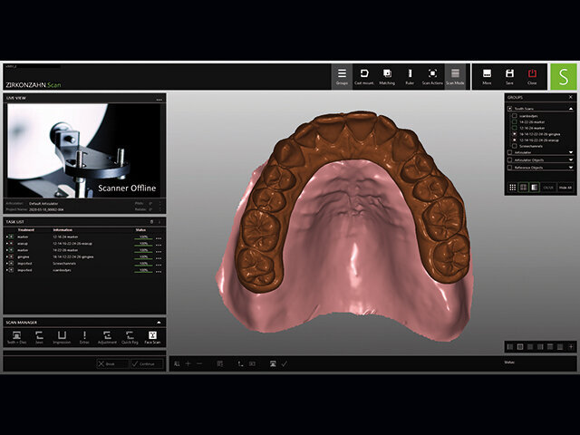 Digitální wax-up přiřazený k naskenované počáteční situaci.