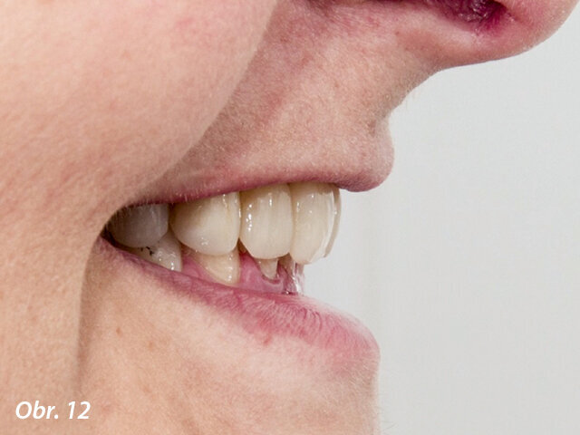 Dobrá podpora horního rtu